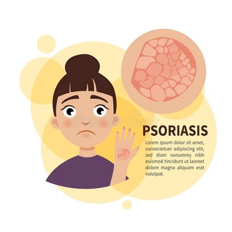 Psoriasis Reasons And Treatment Poster With Info Vector Stock Vector