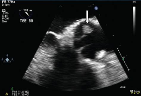 Recurrent Cerebral Infarcts Secondary To Marantic Endocarditis In A