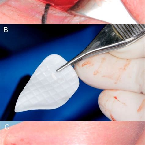 Intraoperative View A The Transconjunctival Approach Exposes The