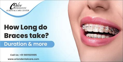 How Long Do Braces Take Duration And More Orion Dental Care Blog