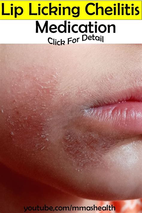 Lip Licking Cheilitis Medication Skin Specialist Skin Treatments