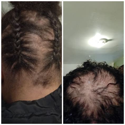Had A Staph Infection On My Scalp And Lost Too Much Hair Waiting