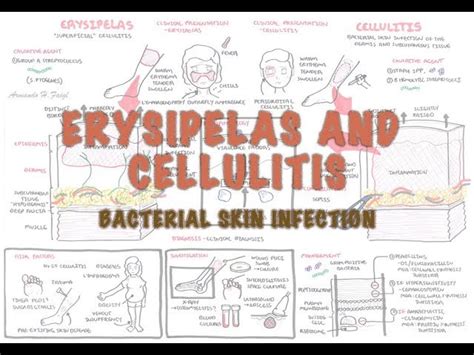 Bacterial Skin Infection Cellulitis And Erysipelas Clinical