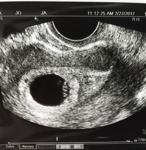 ramzi theory this was from weeks transvaginal ultrasound what do my xxx hot girl