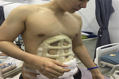 Instant Six Pack Surgery Is A Thing And It Looks Pretty Extreme Daily