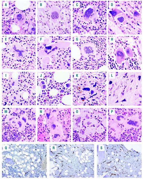 jak2 calr mpl and asxl1 mutational status correlates with distinct histological features in