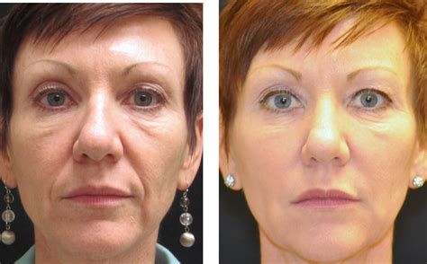 Dermal Fillers Advanced Eye Care