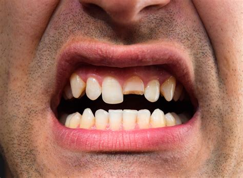 Dente Quebrado Acidentalmente O Que Fazer Odonto Urgente