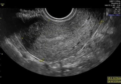Advanced Pelvic Ultrasound In House At Veritas Fertility And Surgery