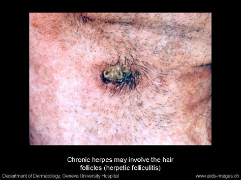 174 likes · 6 talking about this. Herpes Simplex Virus (HSV)/Varicella Zoster Virus (VZV)