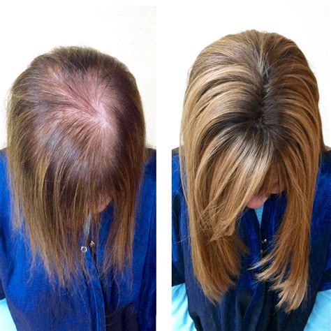How to stop hair loss due to thyroid problems. REVIVE | A REVOLUTIONARY SOLUTION TO HAIR LOSS | Tape in ...