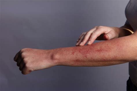 Coronavirus Uk Skin Rashes Could Be Added To Nhs Symptom List Metro News