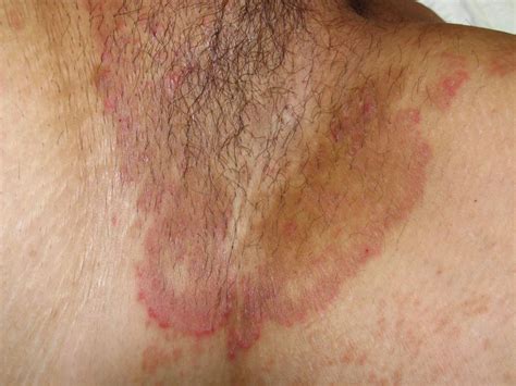 Tinea Cruris Article