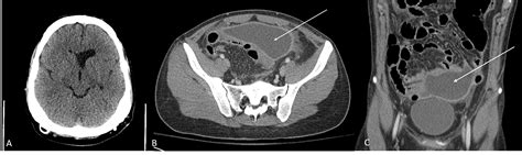 Cureus Nontuberculous Mycobacterial Infection In Patients With