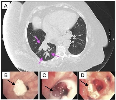 Cureus Bronchoscopic Management Of Endobronchial Atypical Carcinoid