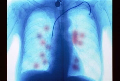 lungenkrebs mit metastasen symptome und behandlung