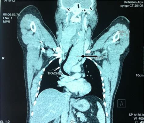Coronal Ct Scan Showing A Giant Goiter Extending Into The Mediastinum