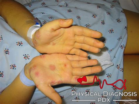Syphilis Rash Physical Diagnosis Pdx