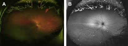 Early Detection of Retinal Abnormalities with Spectral 