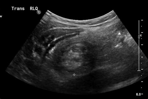 Intussusception Uams Department Of Radiology