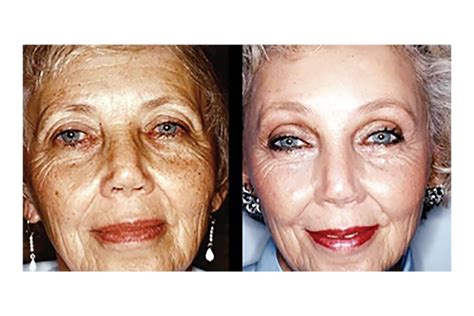 Transforming Your Appearance With Plastic Surgery Plasticsurgerygoal