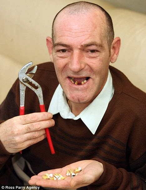 Man Pulls Out 13 Of His Own Teeth With Pliers Dental Resorts