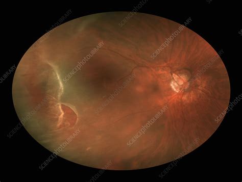 Retinal Tear Stock Image C0306958 Science Photo Library