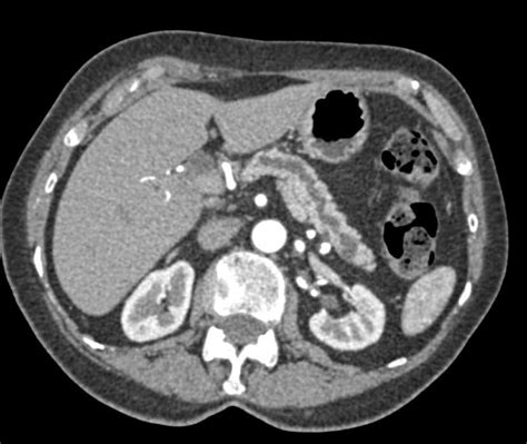Pancreatic Cancer With Double Duct Sign Pancreas Case