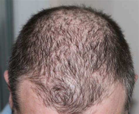 Alopecia Androg Nica Qu Es Causas Y Tratamiento Lui