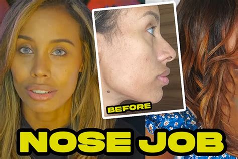 three month septo rhinoplasty and fat transfer update — kylie le beau official website of