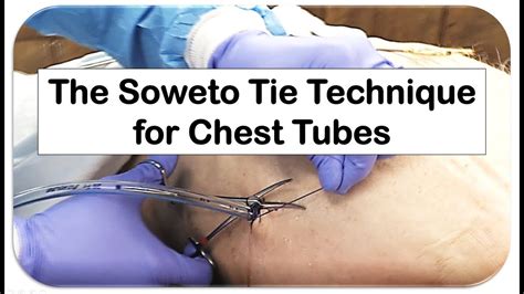 The Soweto Tie For Chest Tubes Youtube