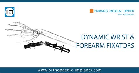 Dynamic Wrist And Forearm Fixators Dynamic Wrist And Forearm Fixators