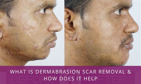 Dermabrasion Scar Removal What How Cost And Recovery