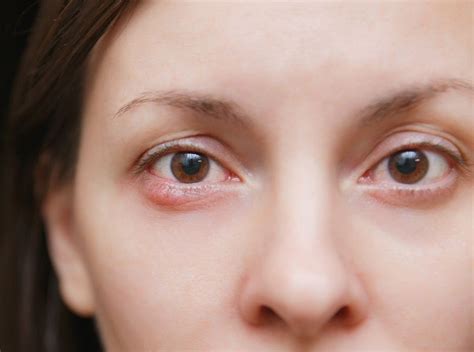 What Causes Styes And How To Avoid Them Valley Eyecare