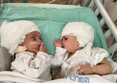 Born Conjoined Back To Back Israeli Twins Finally See Each Other After