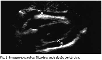 Il suono dello sfregamento del pericardio contro lo strato esterno del cuore. Pericardite: série de 84 casos consecutivos