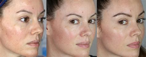 Microneedling Before And After Photos After 2 Treatments Amazing Results