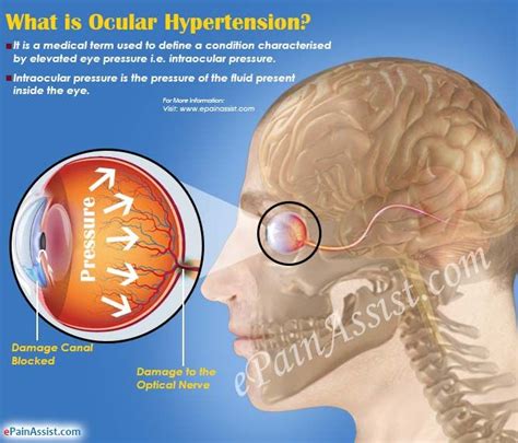 Hipertensión Ocular Causas Síntomas Pruebas Y Tratamiento La Salud