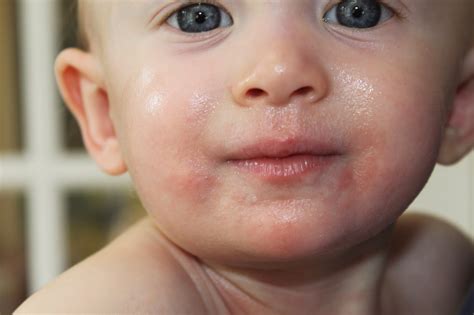 What does a food allergy look like in an infant? Keeping up with the Kiddos: Food Allergy Frenzy