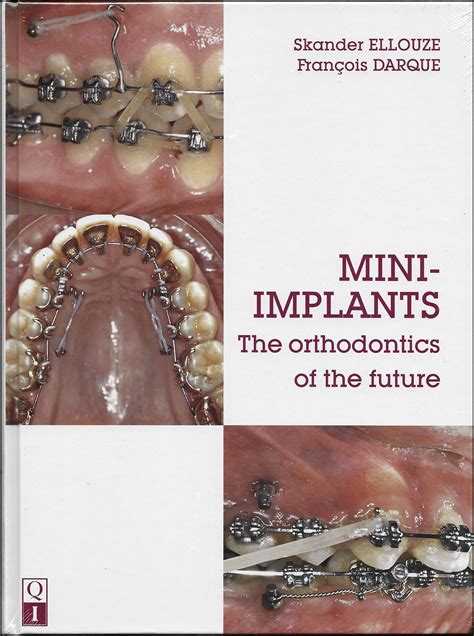 Mini Implants The Orthodontics Of The Future American Journal Of