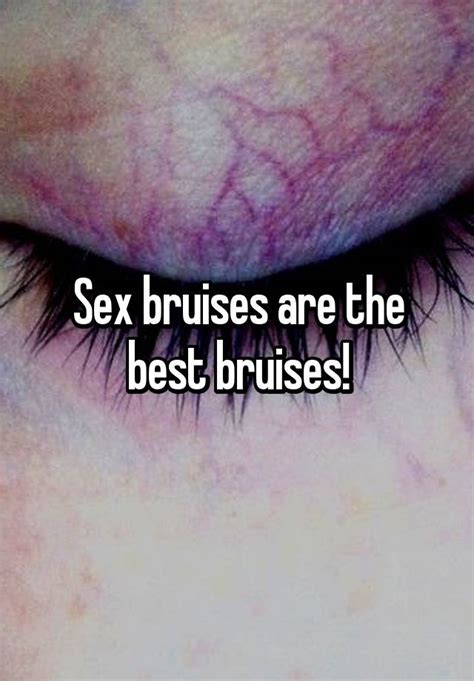 Sex Bruises Are The Best Bruises