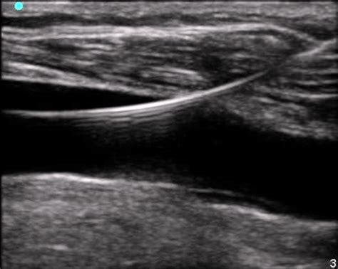 Ultrasound Guided Vascular Access — Mmheme