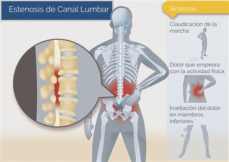 Estenosis De Canal Lumbar Neurocirug A De La Torre