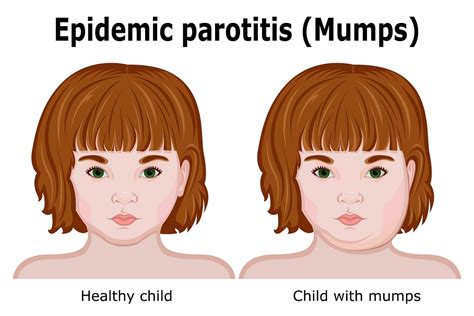 Mumps Symptoms Hseie