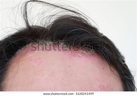 Skin Disease Psoriasis Skin Leprosy Chronic Stock Photo Edit Now