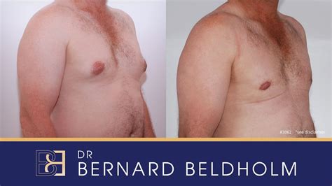 Revision Gynecomastia Surgery Before And After This Patient Saw Dr Beldholm After Having His