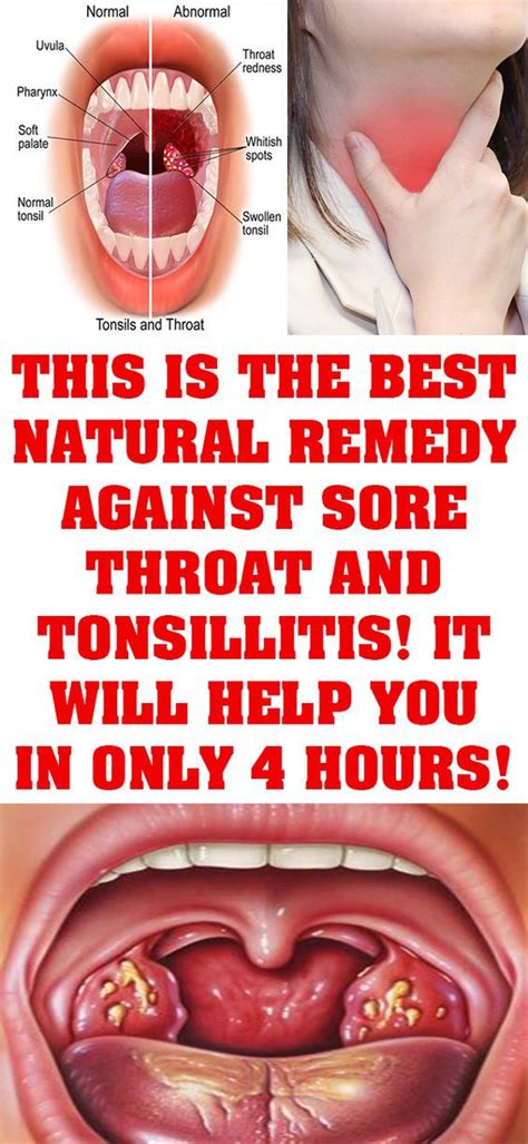 This Is The Best Natural Remedy Against Sore Throat And Tonsillitis It Will Help You In Only 4
