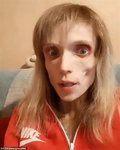 Anorexic Woman Kristina Karyagina Who Weighs Just 38lbs Daily Mail Online