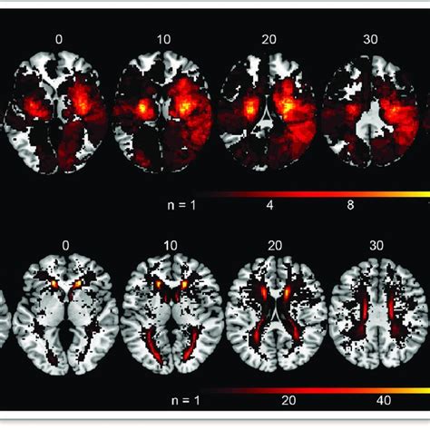 Lesion Overlap Maps A Acute Lesions And B White Matter
