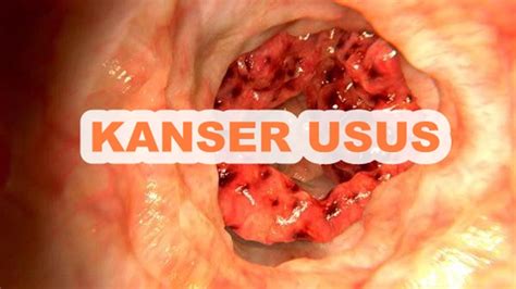 Kanser usus ialah sejenis penyakit yang menyerang usus besar iaitu sama ada kolon, rektum dan dubur. 4 Tanda Kanser Usus Tanpa Kita Sedar - Rahsia Jelita Hawa ...